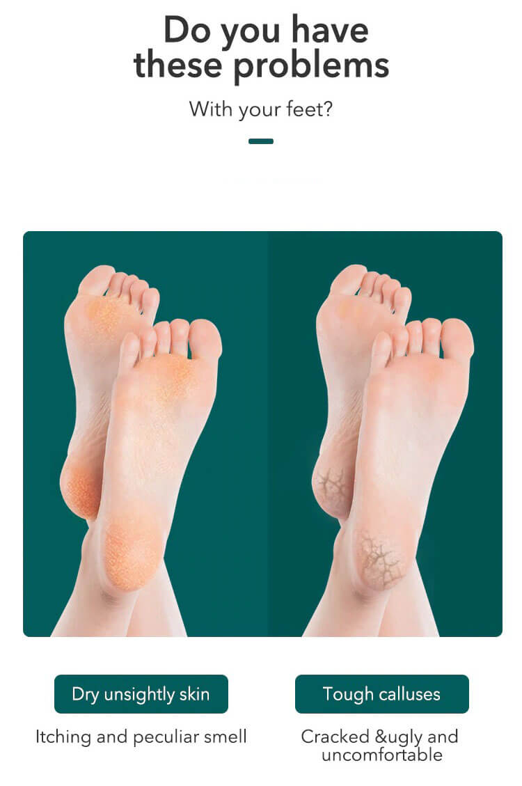Foot Care Pedicure - Pedicure Callus Removal - Chokid